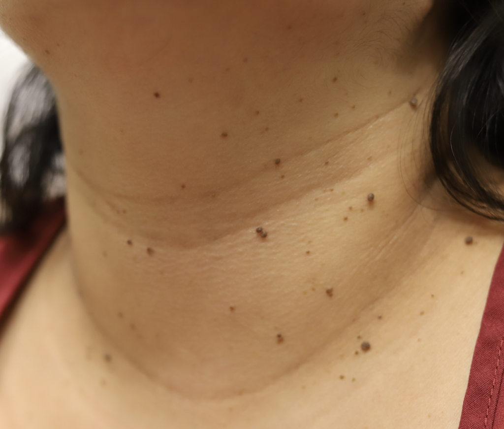 Seborrheic Keratosis on neck
